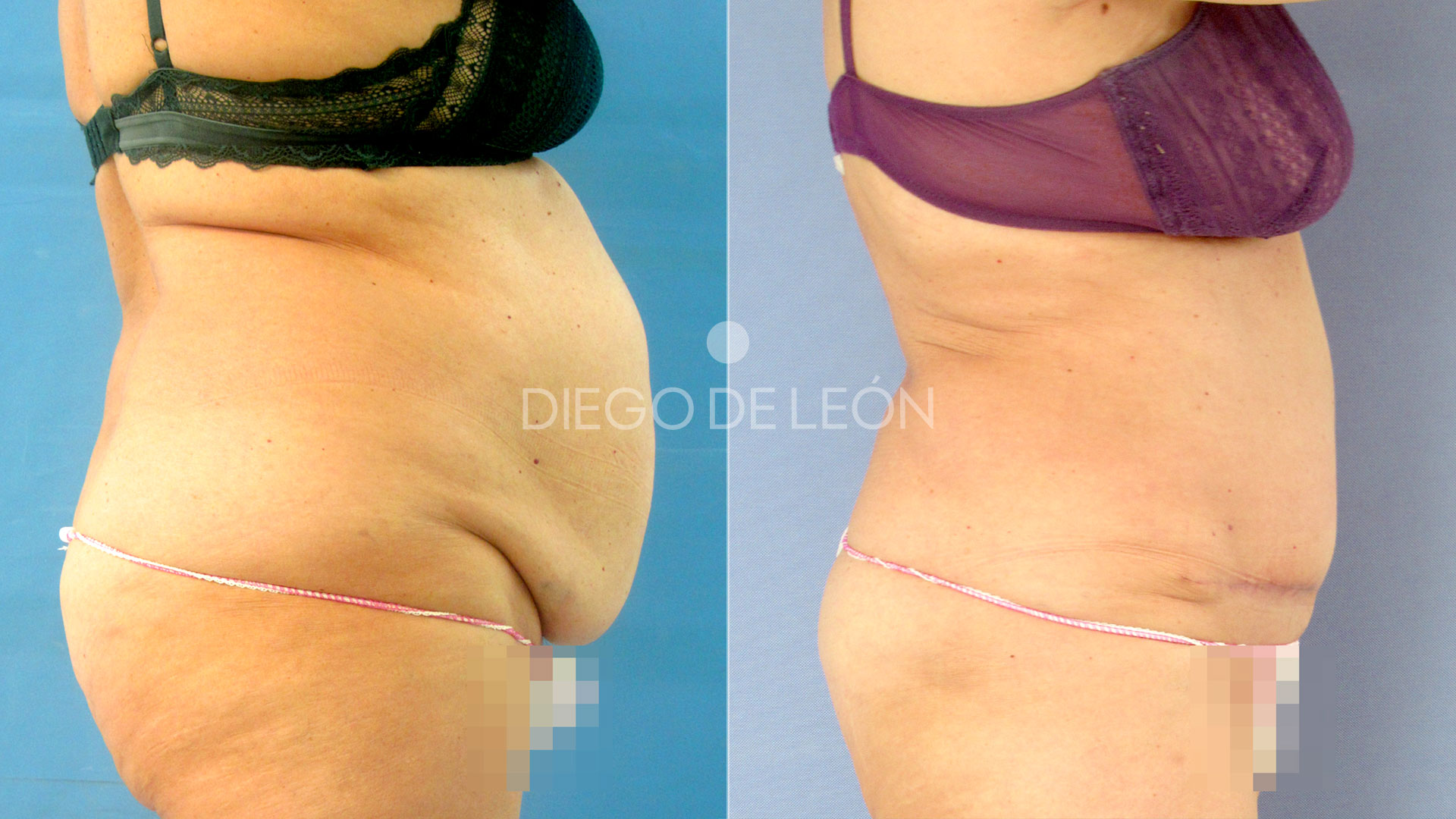Abdominoplastia: Mi experiencia y resultados