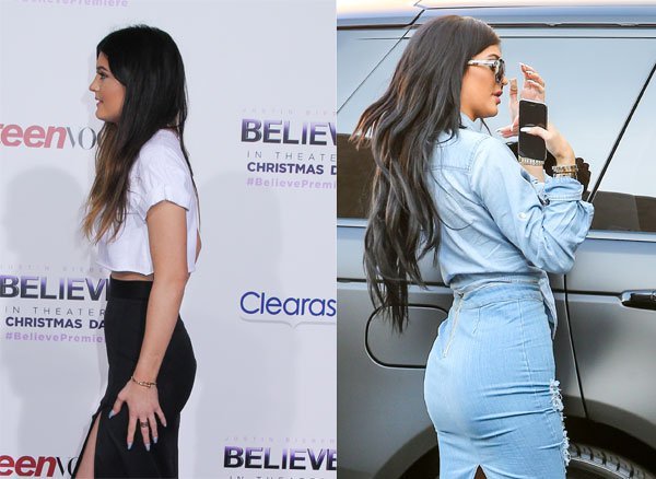Aumento de Glúteos de Kylie Jenner