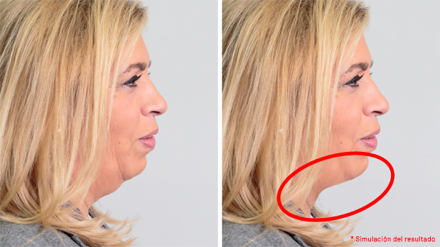 La cirugía de papada en el Reality de Las Campos