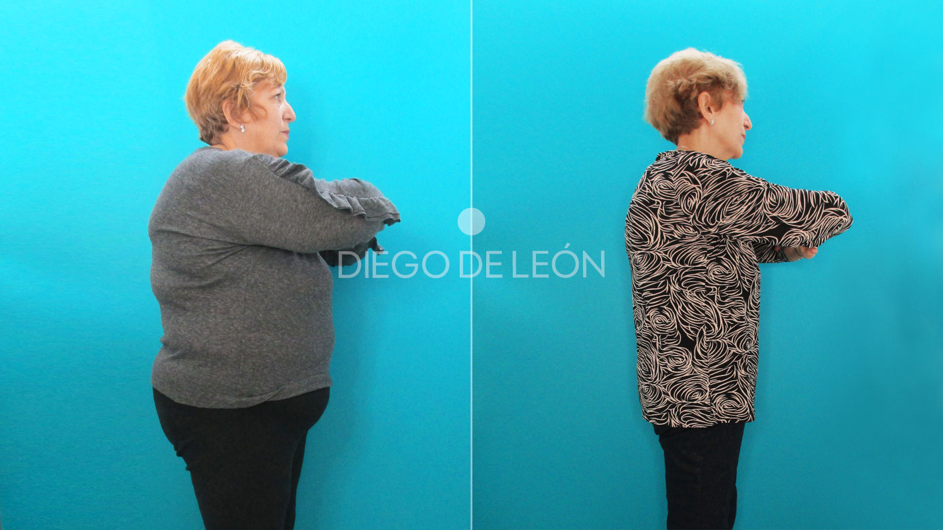 Testimonio Manga Gástrica -47kg