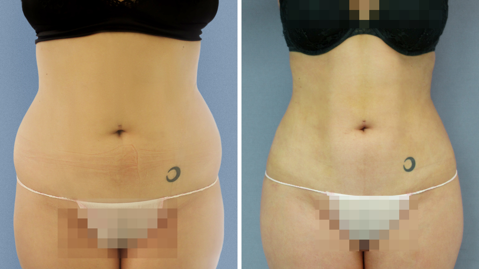 Antes y después: Lipoescultura de alta definición