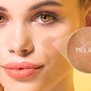 ¿Qué es el melasma facial?