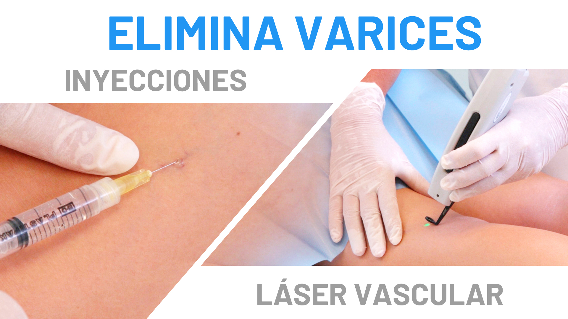 Tratamiento para Varices con Láser y Escleroterapia