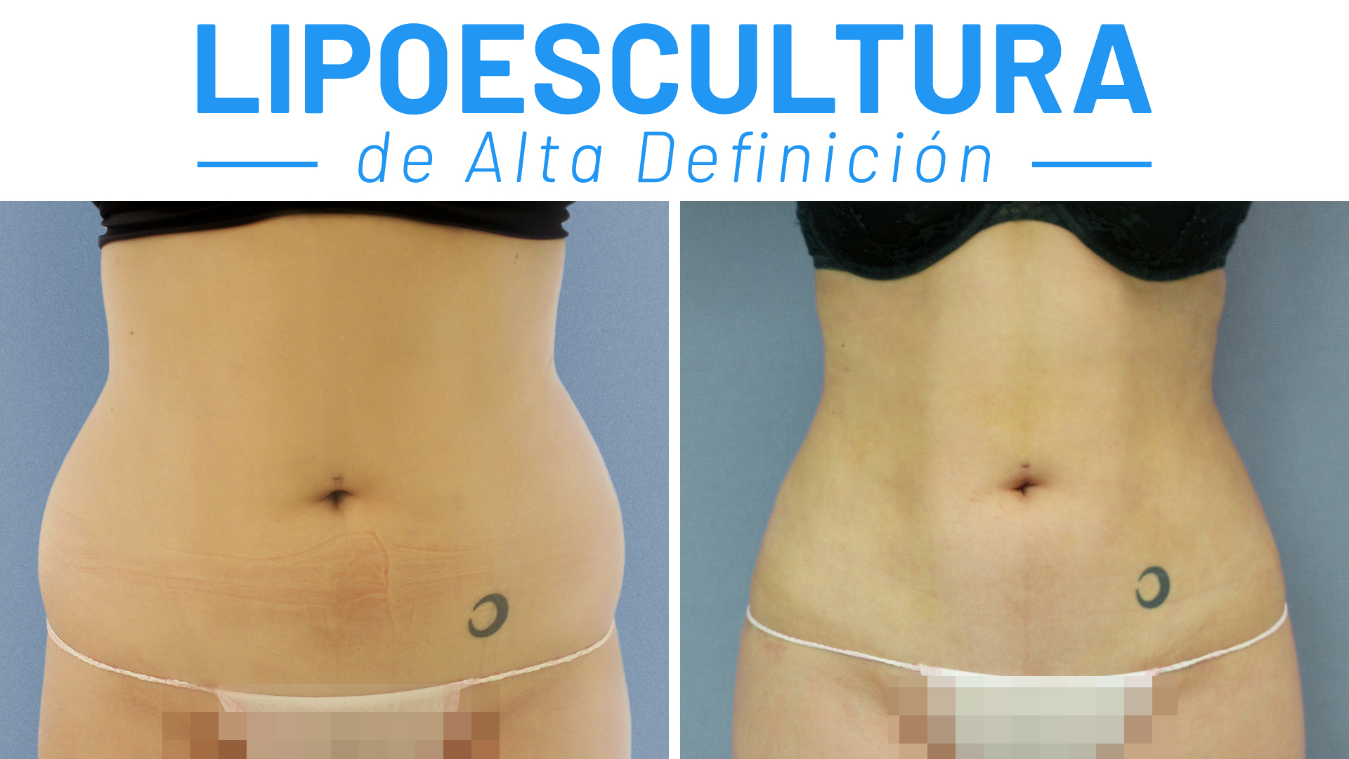 Marichu del Amo en Quirófano: Procedimiento Lipoescultura Váser y Lipotransferencia