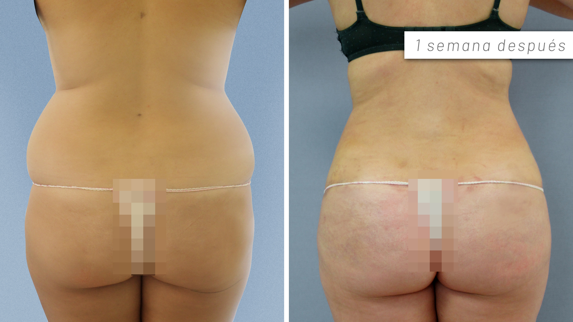Antes y después lipotransferencia glúteos - Clínicas Diego de León Antes y después lipotransferencia glúteos - Clínicas Diego de León