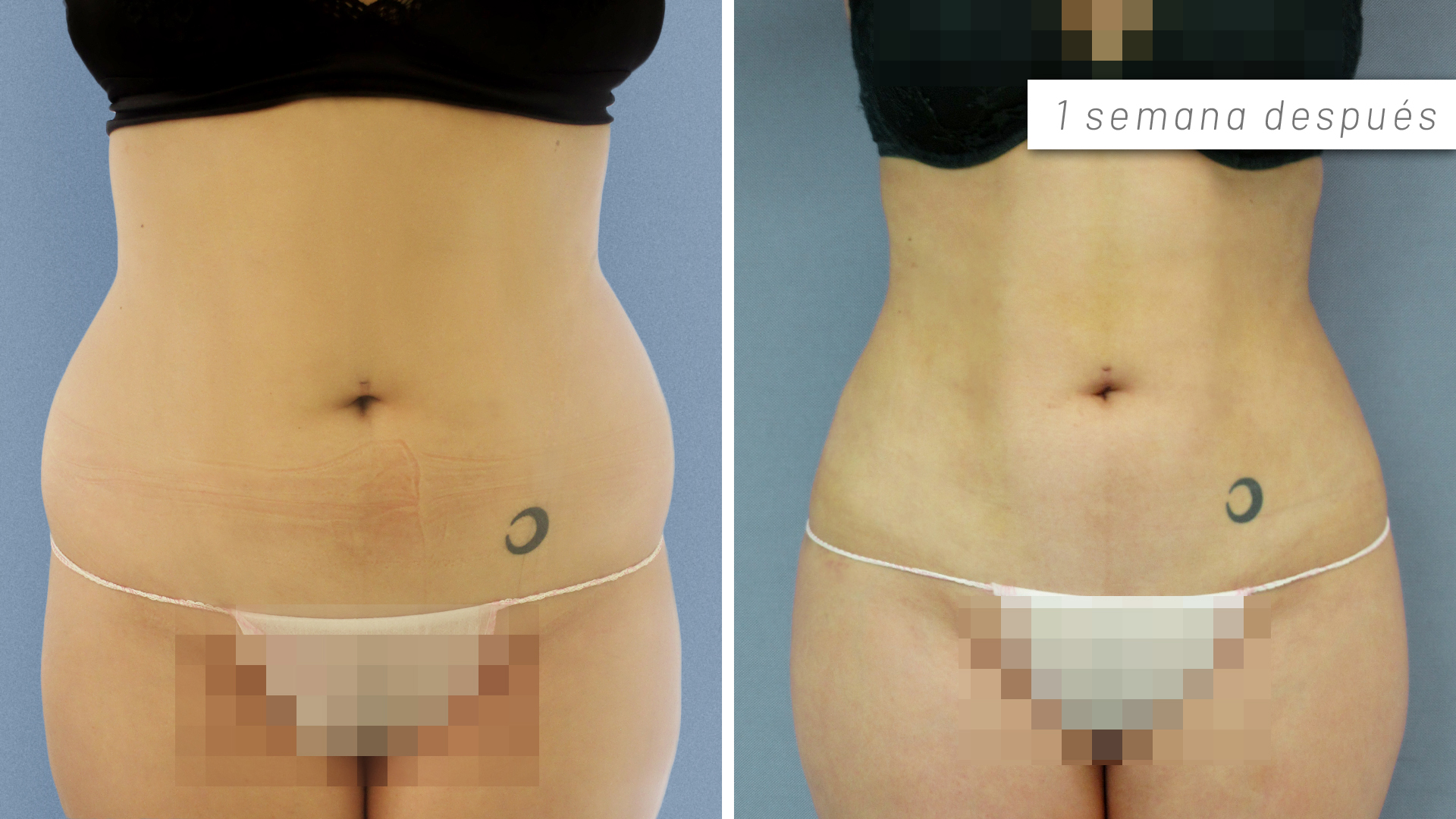 Lipoescultura alta definición y lipotransferencia a gluteo - Antes y después