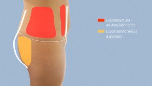 Zonas Lipoescultura de alta definición y lipotransferencia a gluteo