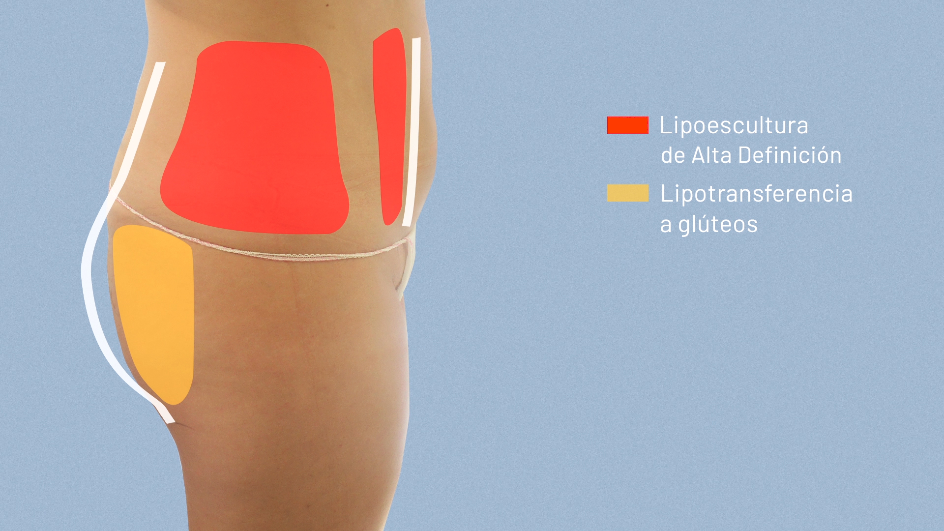 Lipotransferencia a gluteos - Marichu del Amo Lipotransferencia a gluteos - Marichu del Amo