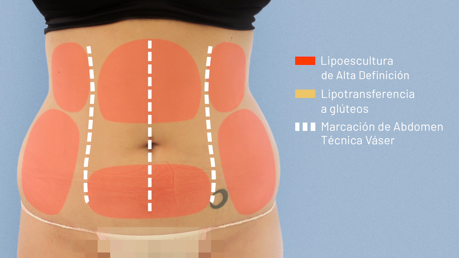 Lipoescultura de alta definición - Técnica Vaser Lipoescultura de alta definición - Técnica Vaser