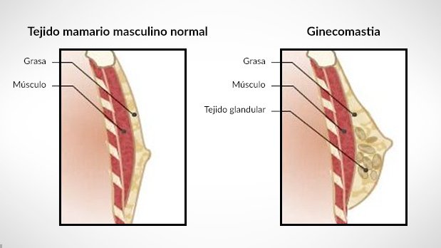 Ginecomastia-hombres