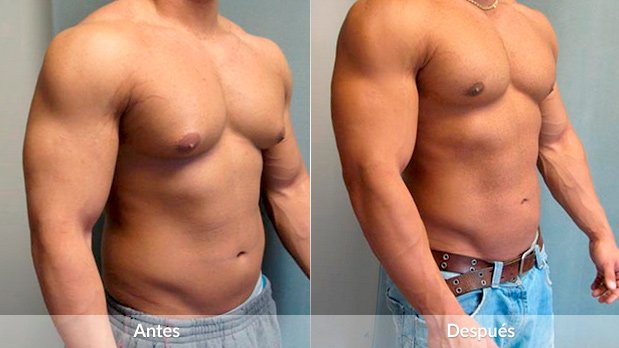 Operación de Ginecomastia 