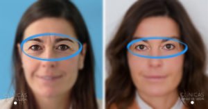 Antes y después BYE BYE ARRUGAS entrecejo mujer