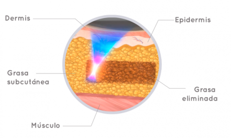 ¿Es posible eliminar la grasa localizada sin cirugía? La verdadera respuesta se llama liposonix
