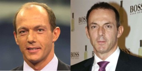 Transplante de pelo - Antes y después Hilario Pino