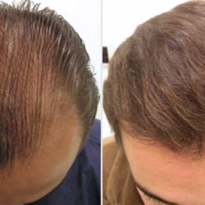 Transplante de pelo - Antes y después