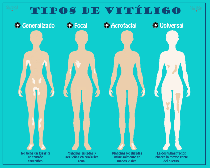 Tipos de vitiligo - Infografía - Clínicas Diego de León