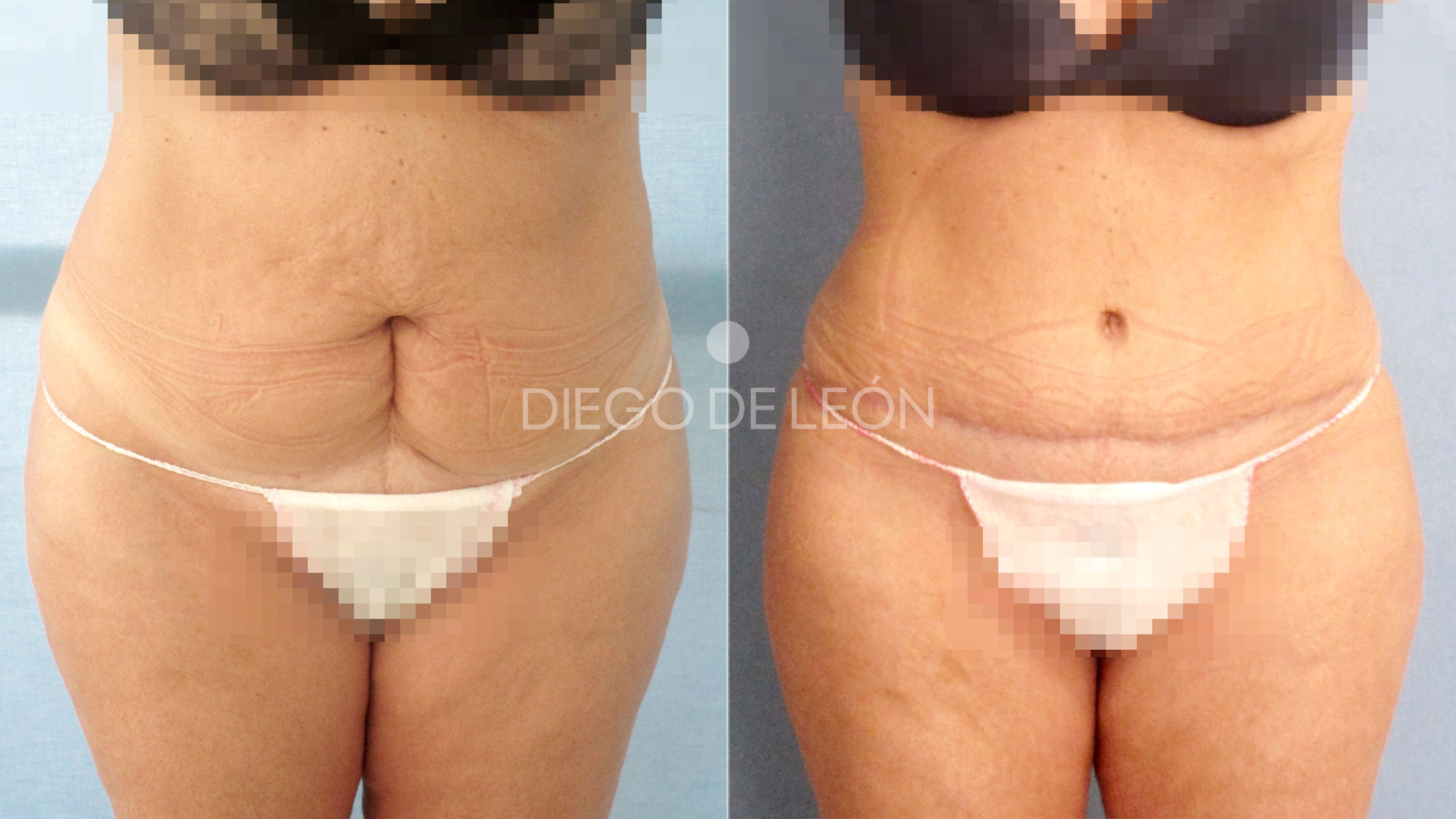 Testimonio Abdominoplastia [Vídeo]
