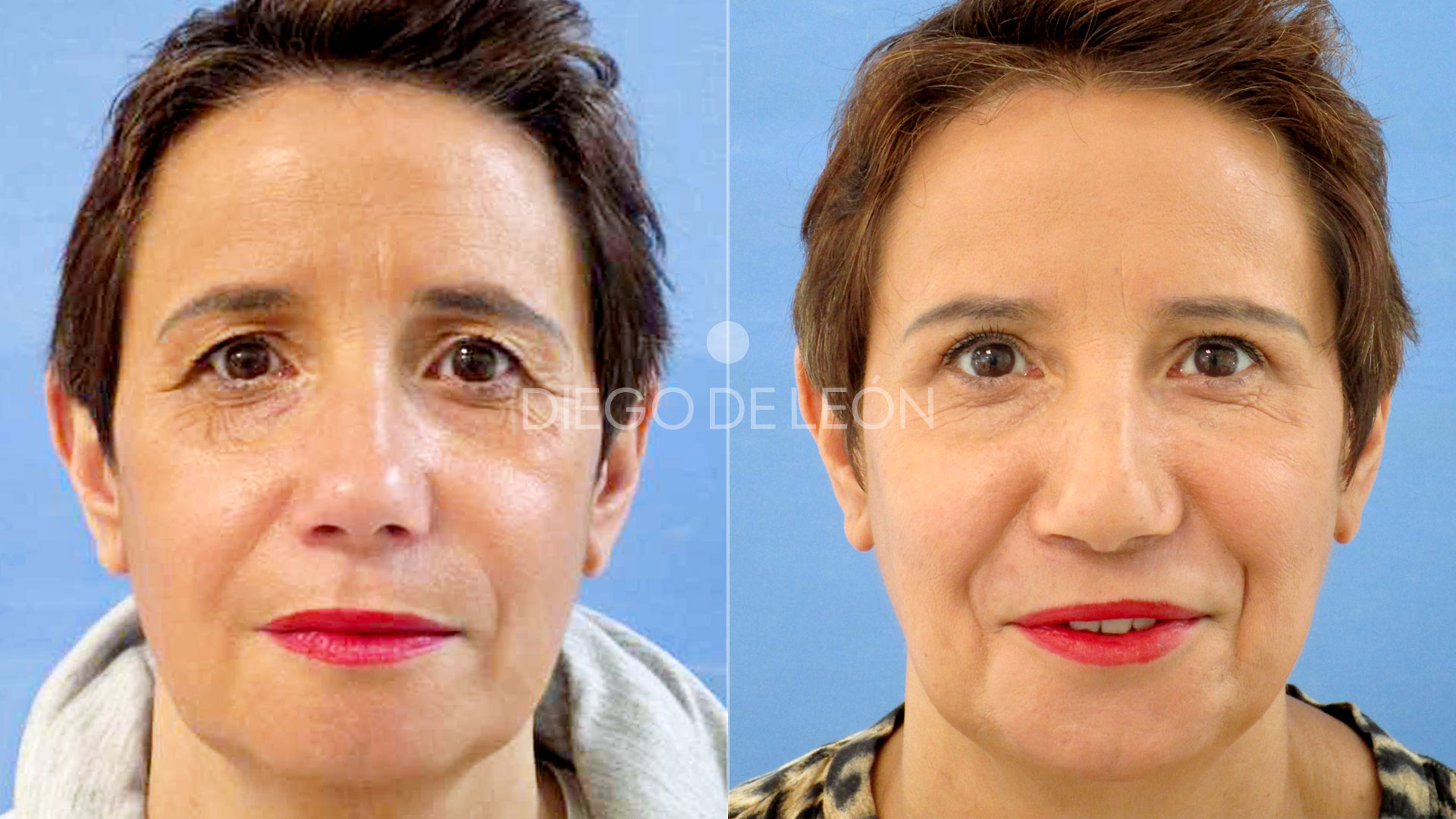 Testimonio Blefaroplastia Superior [Antes y Después]