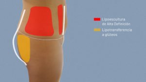 antes-despues-lipovaser