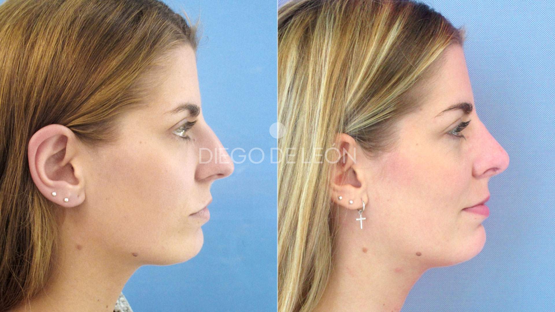 Testimonio de Rinoseptoplastia
