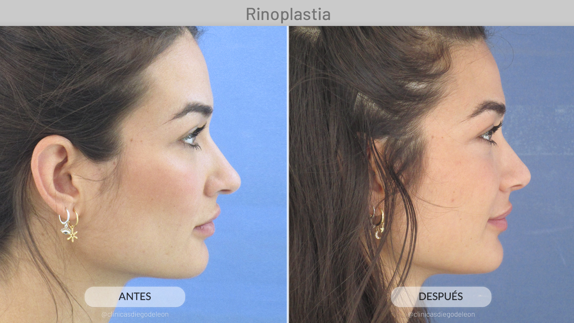 rinoplastia-antesydespues-estelagrande
