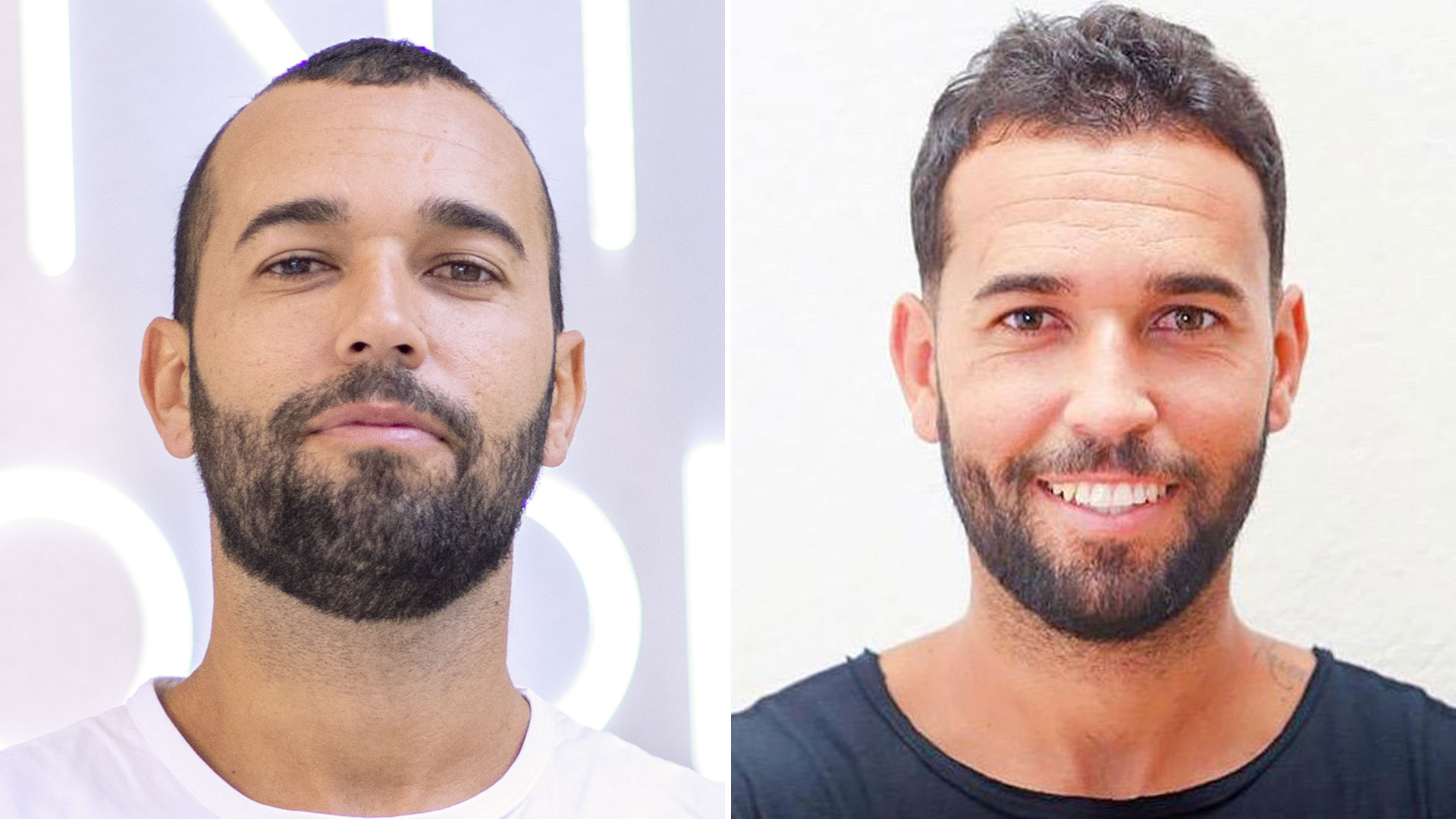 Omar Sánchez muestra el “antes y después” de su injerto de pelo
