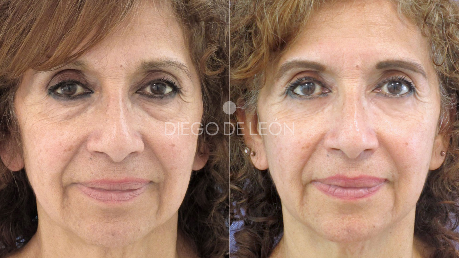 Testimonio: Blefaroplastia Inferior
