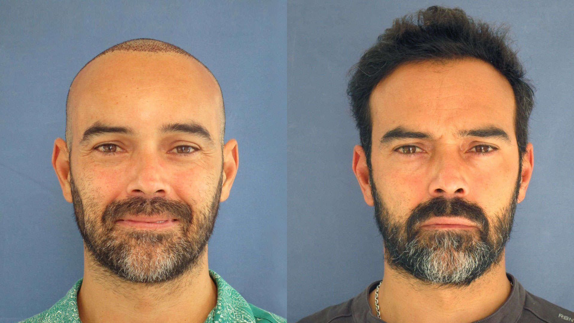 INJERTO DE PELO: El actor Ricardo Rodríguez revela su impactante resultado 10 meses después de la intervención