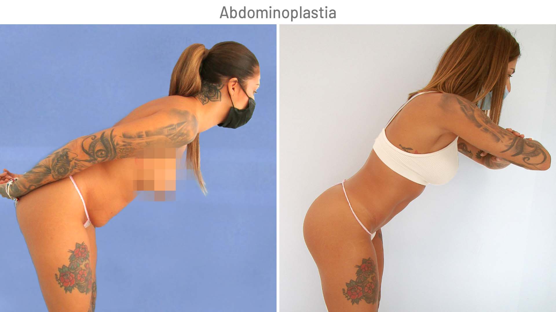 Cristina corrige la flacidez de su abdomen con la abdominoplastia